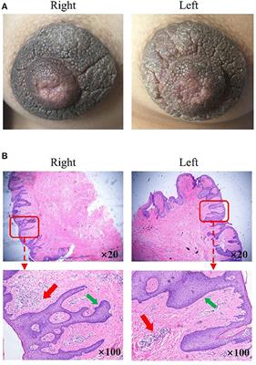 Severe Bilateral Hyperkeratosis of the Nipples and Areolae: A Case Report and Literature Review